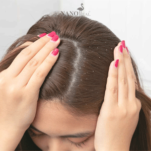 All-about-dandruff-and-how-to-treat-it-min